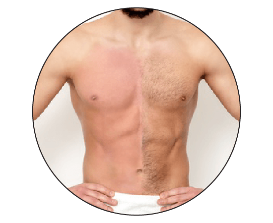 Laser Hair Removal For Men By Best Mokosh Skin Hair Clinic 